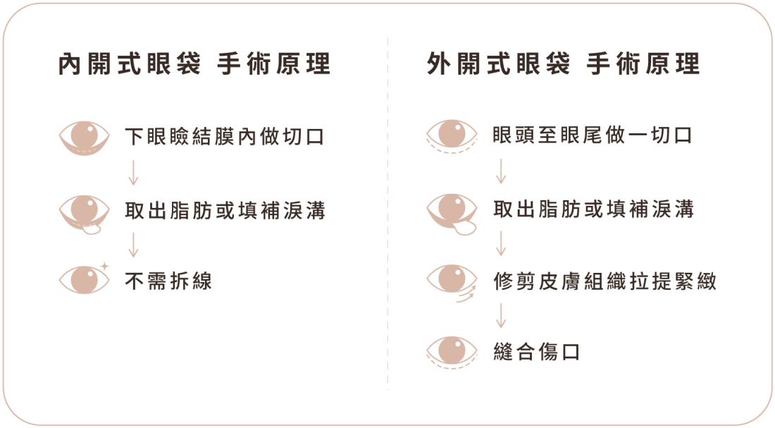 眼袋手術 手機版 手術原理