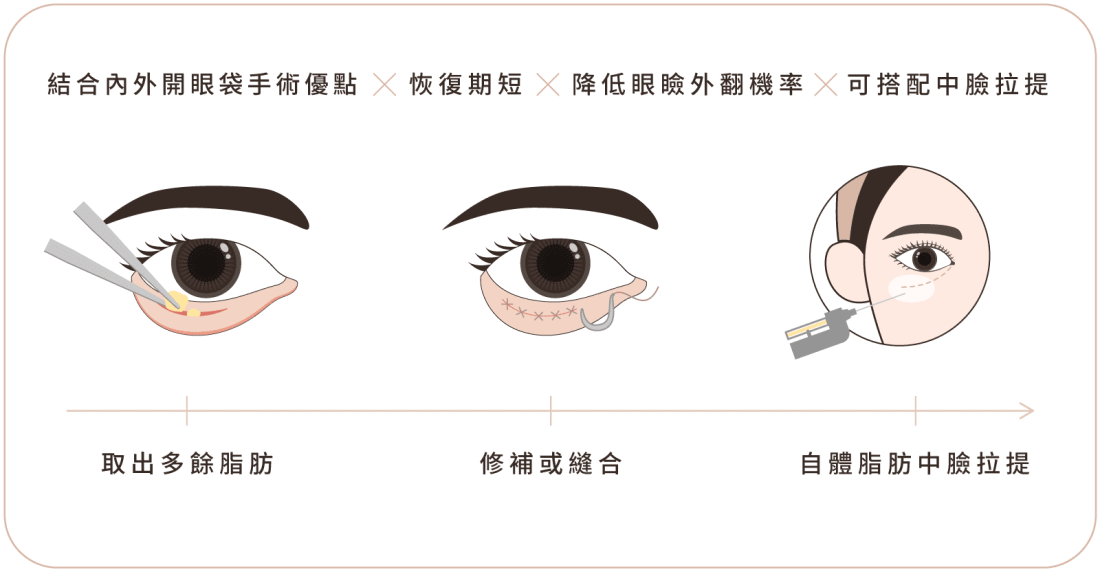眼袋手術 手機版 手術流程