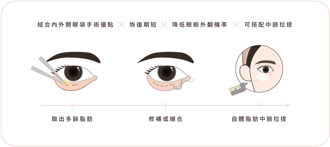 眼袋手術 手術流程