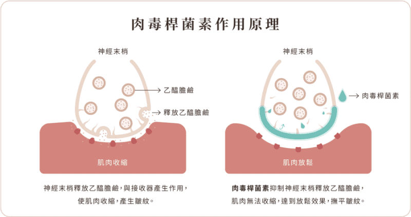 肉毒桿菌素 肉毒原理