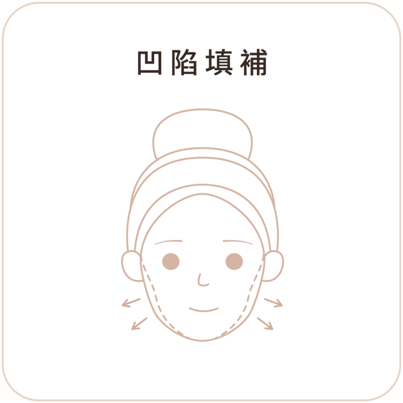 洢蓮絲少女針 安心選用 01