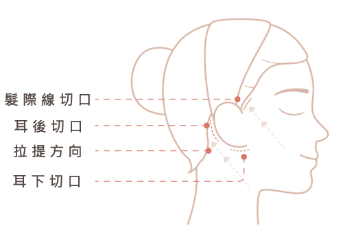 內視鏡微創拉皮手術 中下臉拉皮