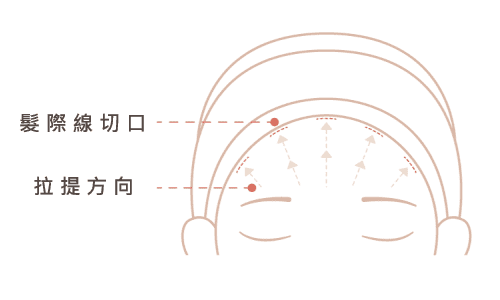 內視鏡微創拉皮手術 前額拉皮