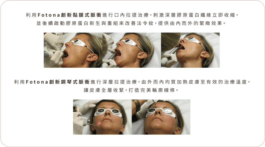 Fotona4D 美塑拉提 功能介紹