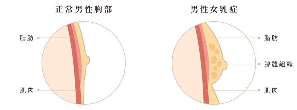 男性女乳症 小知識圖解