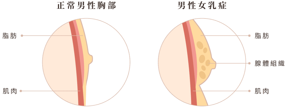 男性女乳症 手機版 小知識圖解