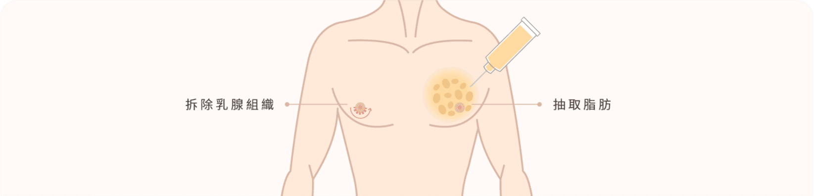 男性女乳症 治療方式 首圖
