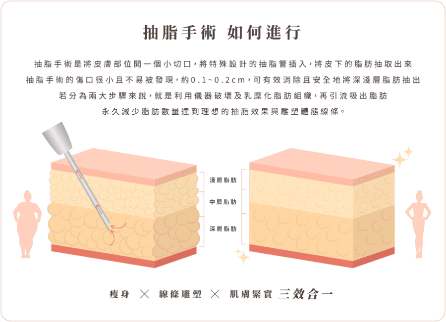 抽脂 抽脂手術流程