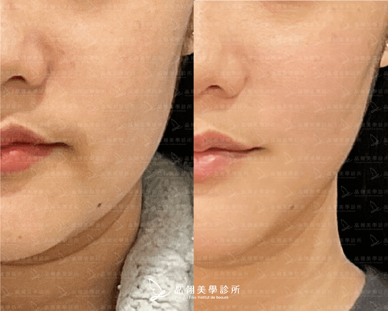 嘴邊肉音波案例分享李小姐(晶翎美學診所)