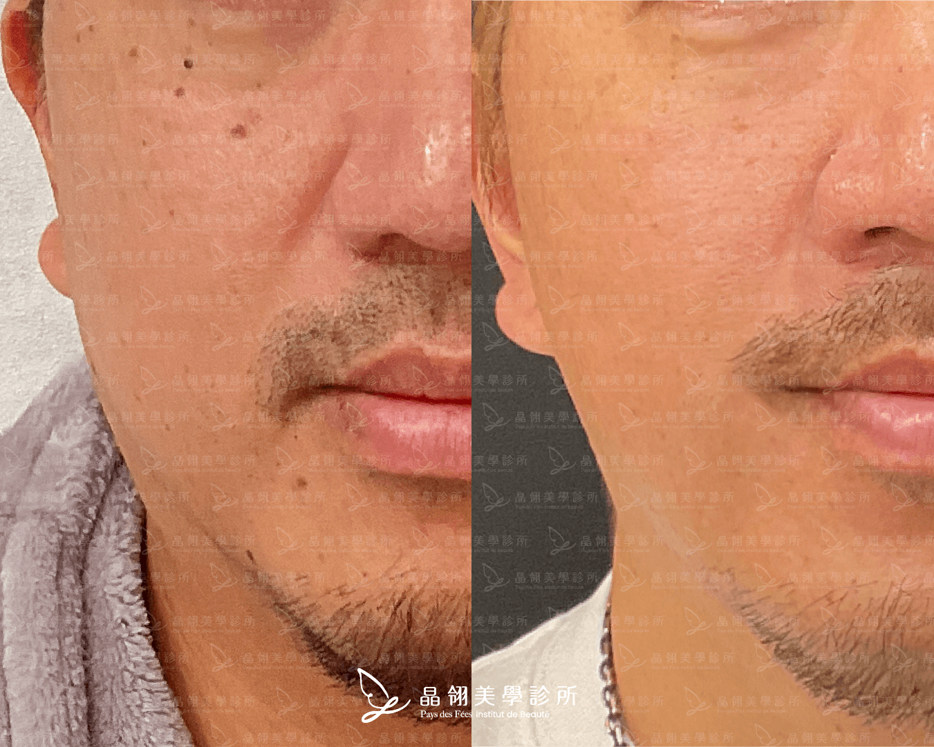嘴邊肉音波案例分享陳先生(晶翎美學診所)