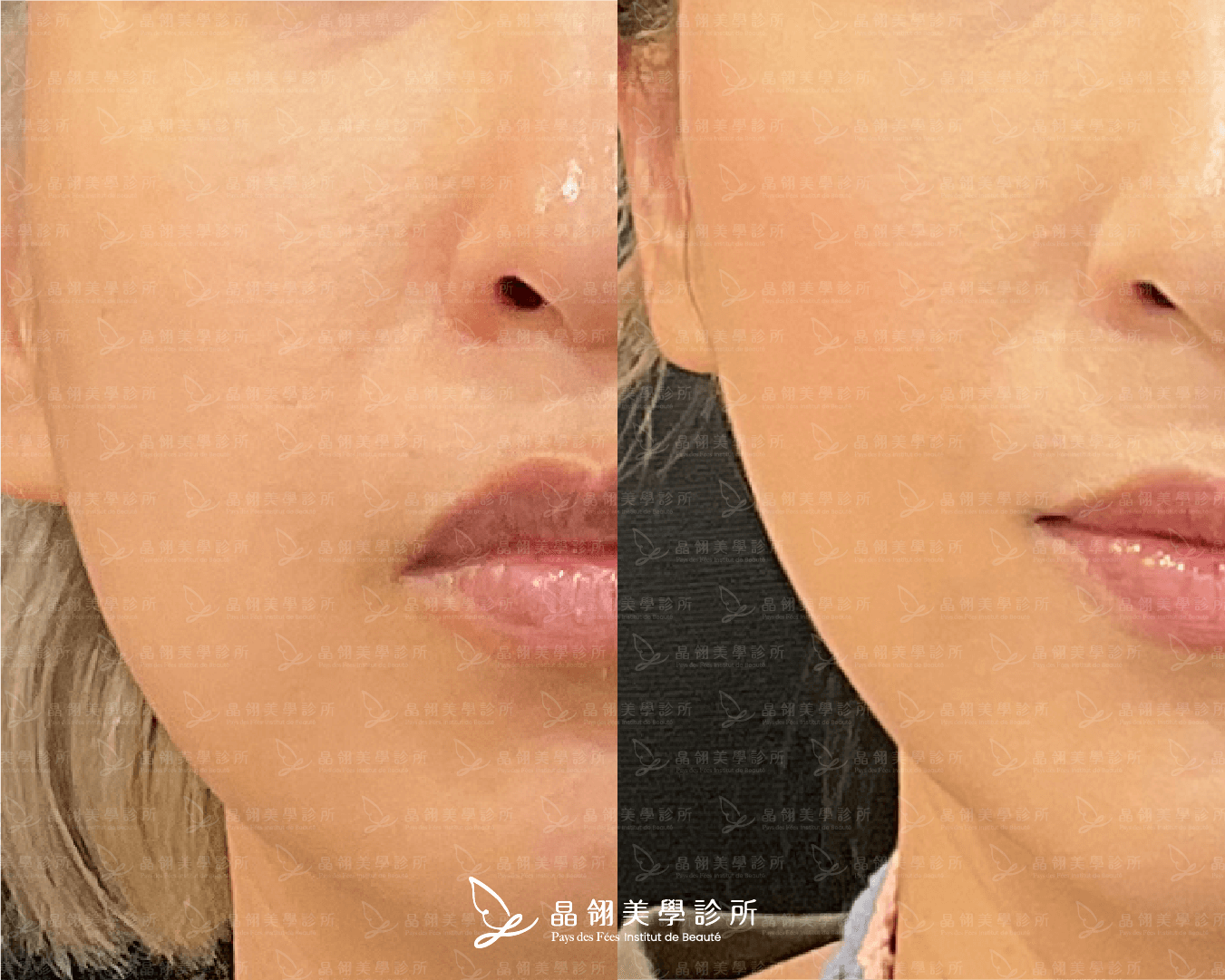 嘴邊肉音波案例分享藍小姐(晶翎美學診所)