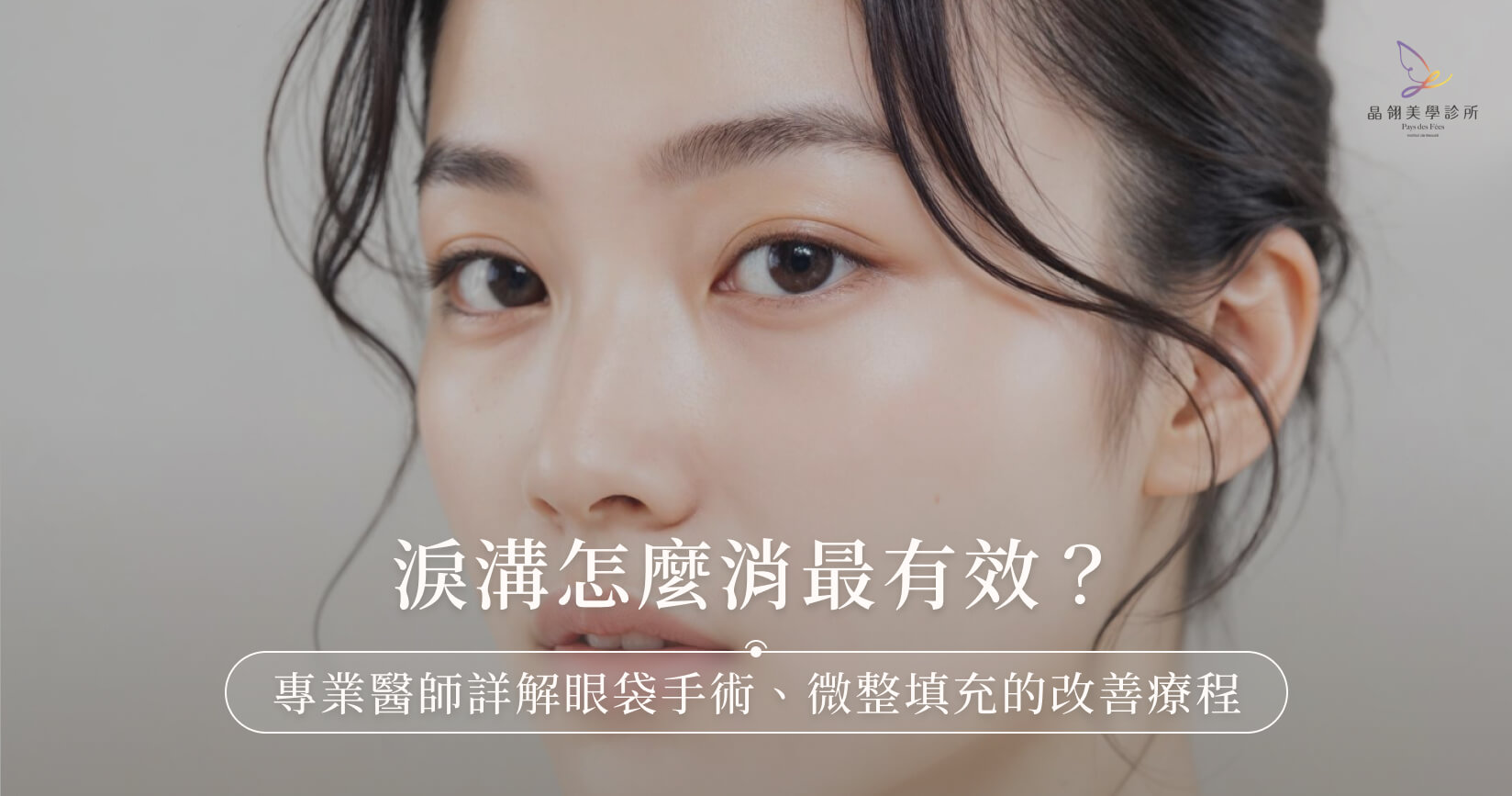 淚溝怎麼消最有效?專業醫師詳解眼袋手術、微整填充的改善療程 淚溝怎麼消最有效?專業醫師詳解眼袋手術、微整填充的改善療程