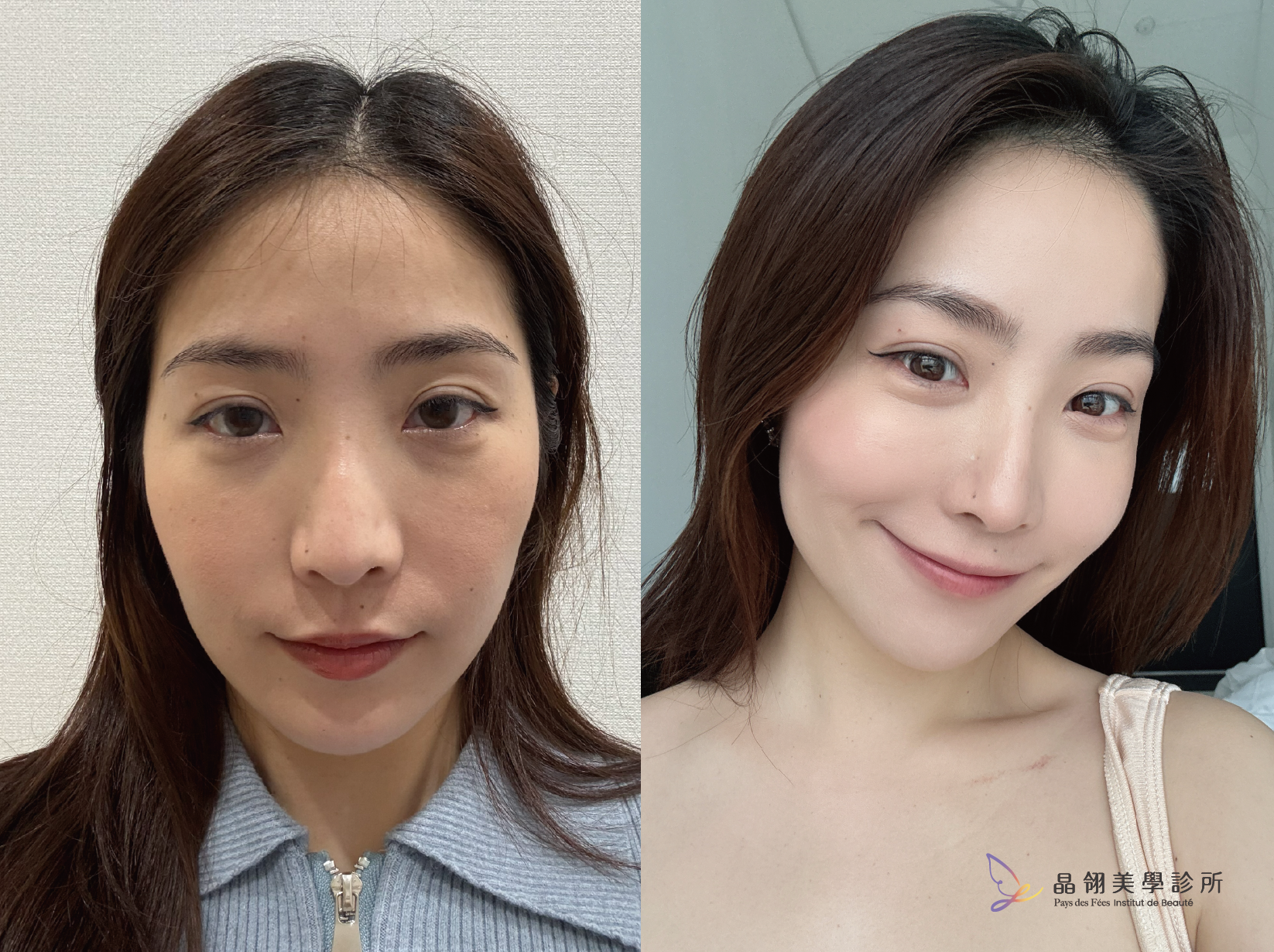 真實分享|眼下浮腫、表情僵硬?從「眼下毛毛蟲」到自然神情的微整修復之路_工作區域 1 複本 3.png