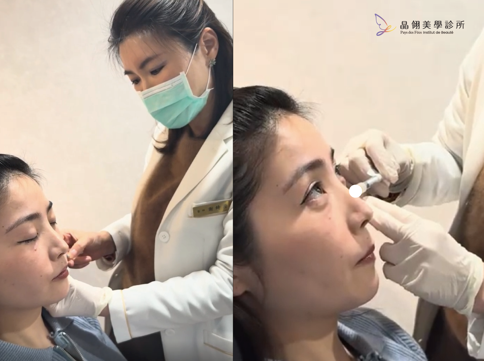 真實分享|眼下浮腫、表情僵硬?從「眼下毛毛蟲」到自然神情的微整修復之路_工作區域 1 複本 2.png