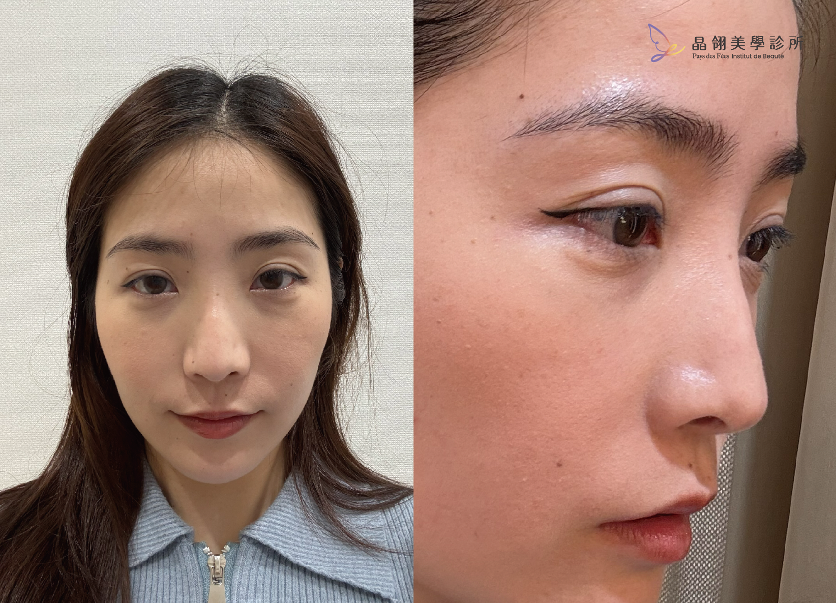 真實分享|眼下浮腫、表情僵硬?從「眼下毛毛蟲」到自然神情的微整修復之路_工作區域 1 複本.png