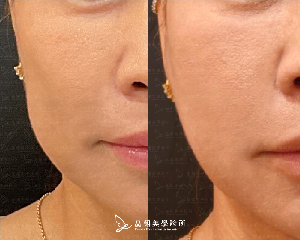 晶翎美學「逆時針」臉頰凹陷案例
