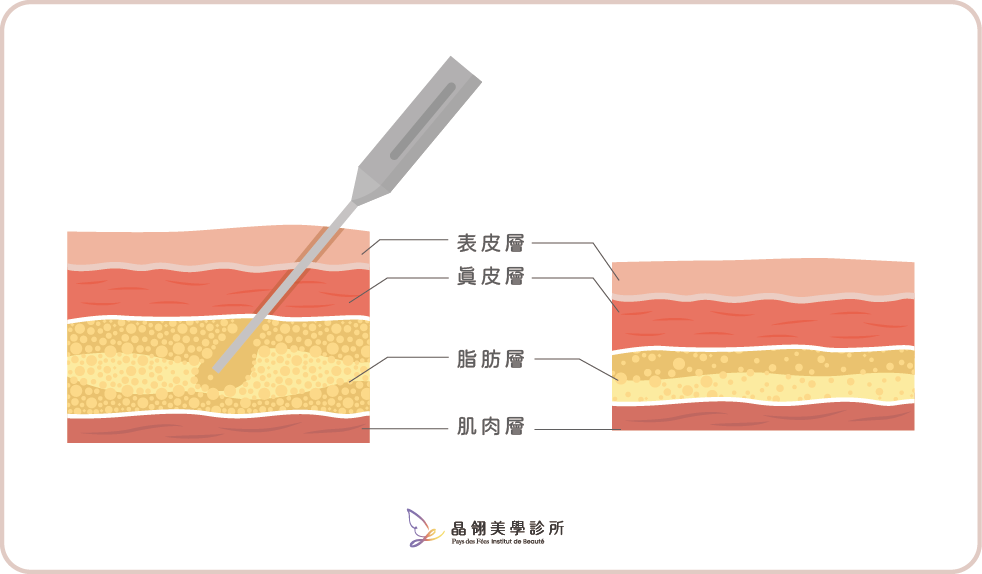 抽脂手術完整攻略:原理是什麼?適合哪些人?費用與療程怎麼選一次說清楚-04.png