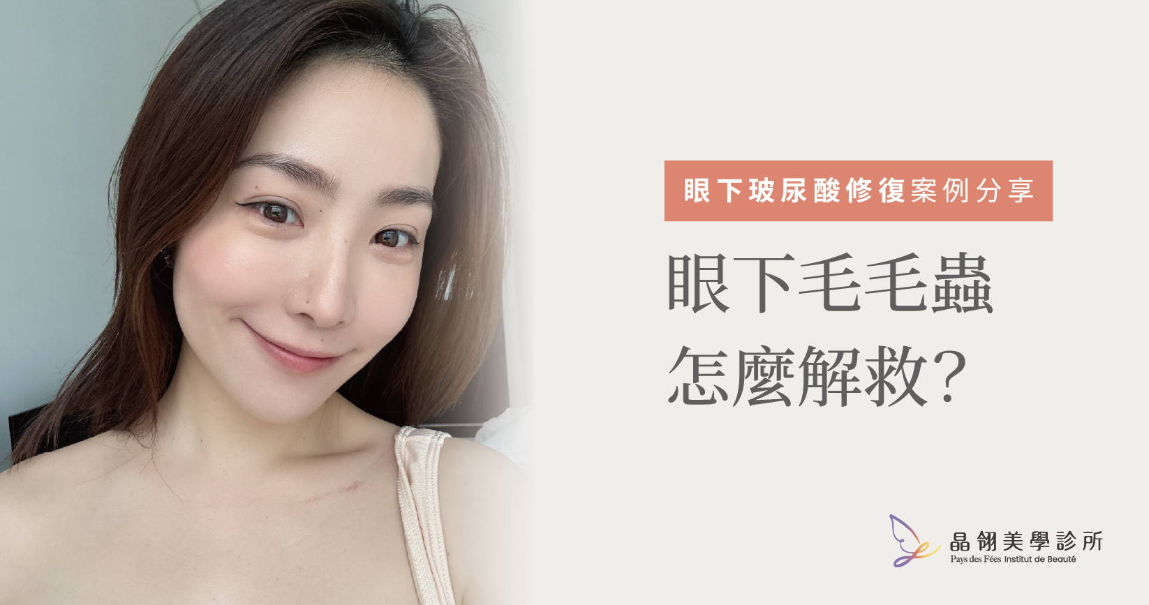 真實分享|眼下浮腫、表情僵硬?從「眼下毛毛蟲」到自然神情的微整修復之路_工作區域 1.png