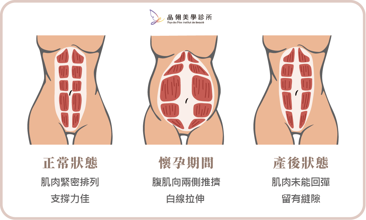 【完整指南】產後腹直肌分離怎麼辦?從自我檢測到治療方式一次看懂_工作區域 1 複本.png